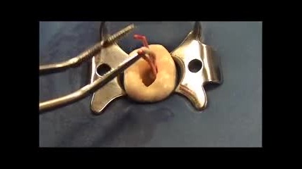 endo rez accelerator technique 