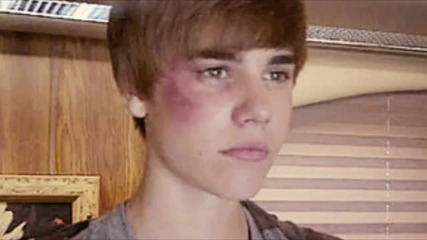 Justin Bieber с насинено око... 
