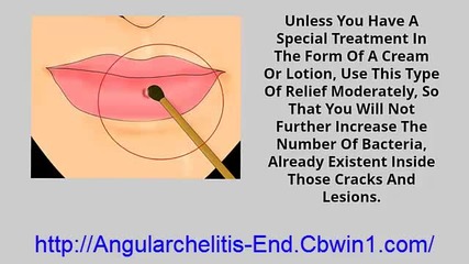 Angular Chelitis, Angular Cheilitis Pictures, Angular Cheilitis Vitamin Deficiency, Cheilitis Cause