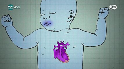 Почти 1,5 млн. бебета в света се раждат със сърдечни проблеми