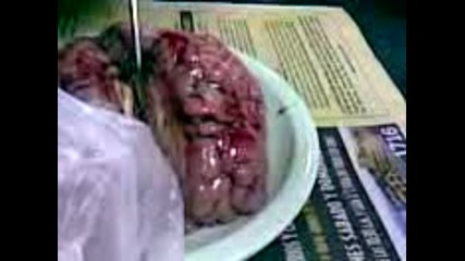 Operazia na mozak - Djefera