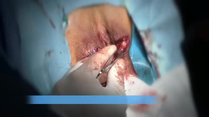 Labiaplasty- вагинална пластична хирургия