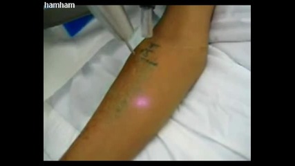 Лазерно премахване на татуировка
