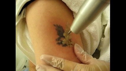 Премахване на татуировка с лазер 