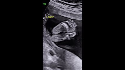 Година след аборта: Джеси Джей обяви, че отново е бременна