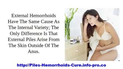 How To Get Rid Of Piles, External Hemorrhoid Treatment, How To Get Rid Of Piles Naturally And Quickl