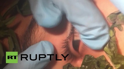 В Перу премахват червей от окото на момче