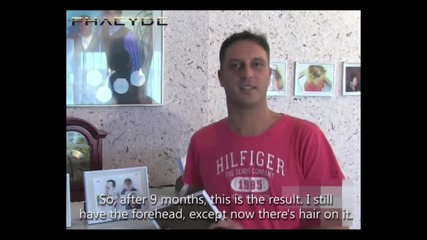 Result of Hair Transplant - With Before and After Pictures - Phaeyde Clinic