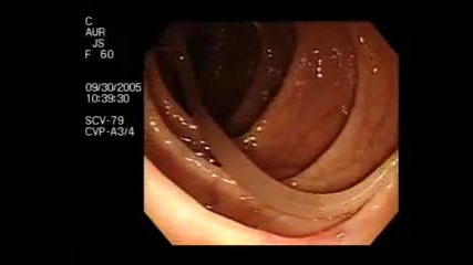 Colonoscopy Demonstrating a Moving Worm