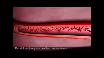 Ангина пекторис - Angina animations