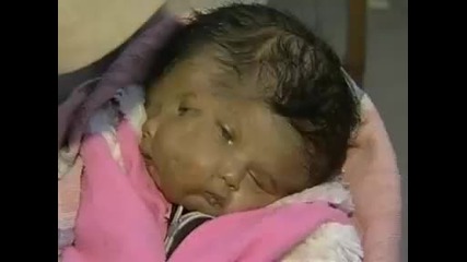Бебе се е родило с две лица, четири очи , два носа , две усти