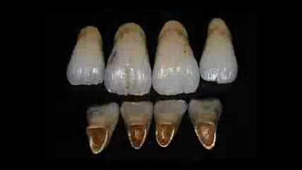 Изкуствени Зъбни Корони На Горила
