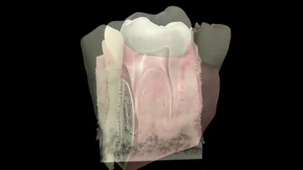Зъбни абсцеси 3d видео