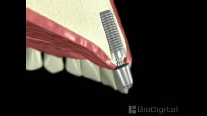 имплантиране на зъб