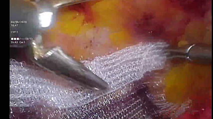 bobys ing-hernia