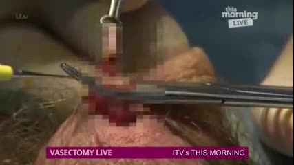 Вазектомия по телевизията шокира зрителите рано сутринта
