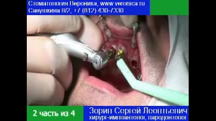как се имплантират зъби- 2 част