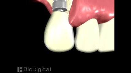 3d Animation Of A Dental Implant Procedure