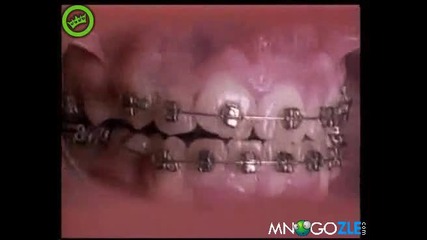 Eфектът от 18 месеца със шини за зъби
