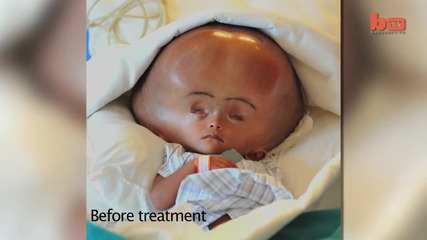 Нова надежда за бебе с отоци в главата