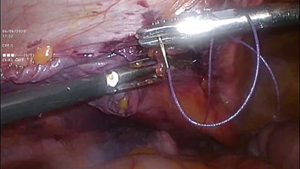 bobys ing-hernia