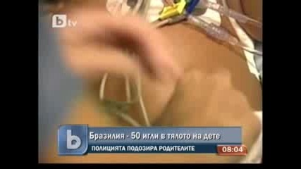 Откриха 50 игли в тялото на двегодишно дете