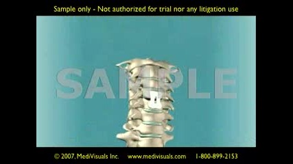 3d Medical Animation Anterior Cervical Fus