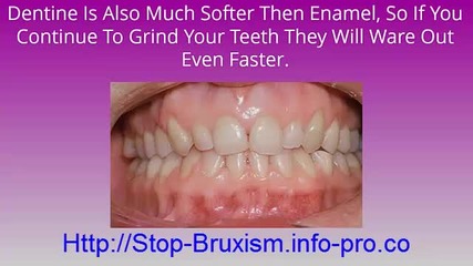 Teeth Grinding In Children, Treatment For Bruxism, Nighttime Teeth Grinding, Bruxism Definition