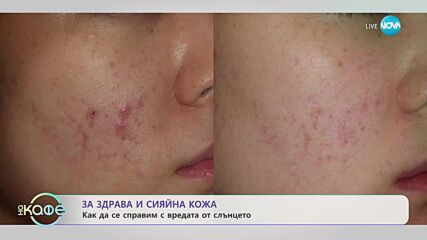 За здрава и сияйна кожа - „На кафе” (26.09.2023)