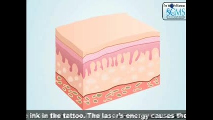 Полезно - Как да си премахнем татуировката чрез лазер 