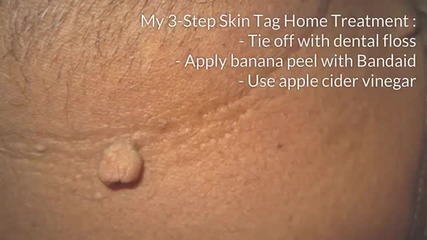 3 Skin Tag Removal Treatments That Clear Skin Tags Fast
