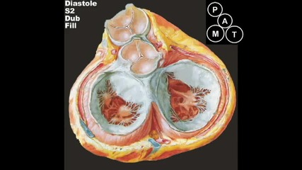 Митрална регургитация - Mitral Regurgitation Murmur