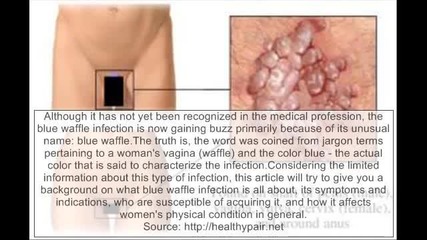 All About Blue Waffle Disease