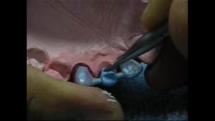 Зъботехника-фронтален мост- 2 част