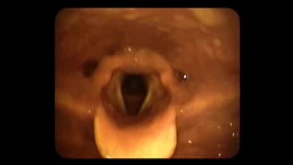 Video Stroboscopy of the Vocal Cords 