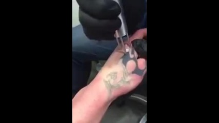 Апарат за лазерно премахване на татуировки