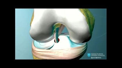 Предна кръстна връзка - Anterior Cruciate Ligament (acl) Reconstruction Animation