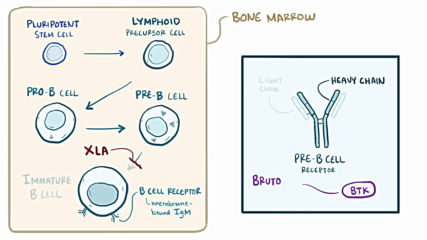 X linked agammaglobulinemia Bruton agammaglobulinemia - causes symptoms