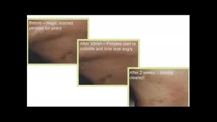 Eumora Facial Bar- Before & After Pics!