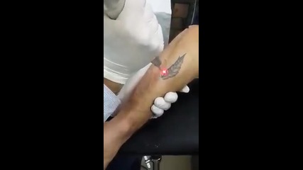 Премахване на татуировка с лазер