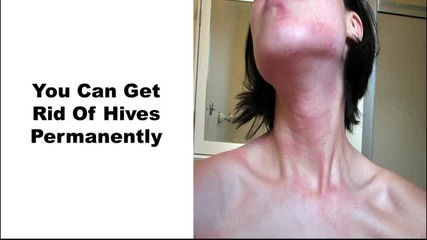 Relief From Hives