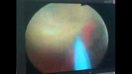 Разбиване на камъни с холмиум лазер в Хил клиник 