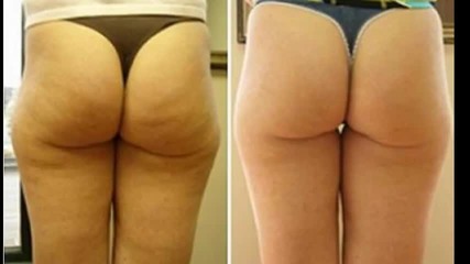 Анти - целулитен крем чудо - Преди и След