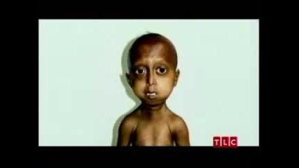 Индийски деца страдащати от неизлечамата болест Прогериа