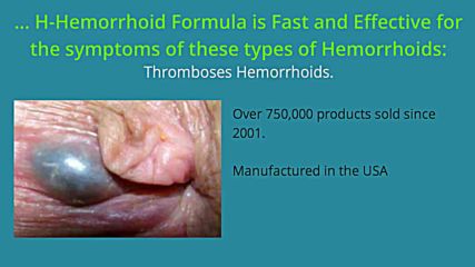 Amazing Natural Hemorrhoid Treatment oil cures hemorrhoids fast