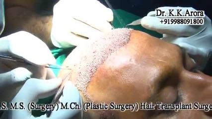 Hair Transplant Surgery In India