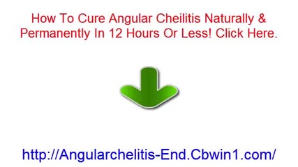 Angular Cheilitis Treatment, Angular Cheilitis Home Remedies, Chronic Angular Cheilitis