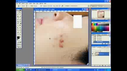 Remove Pimples In Photos Using Adobe Photo