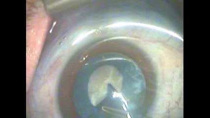 Катаракта (перде) на окото - хирургично лечение, напреднал стадий