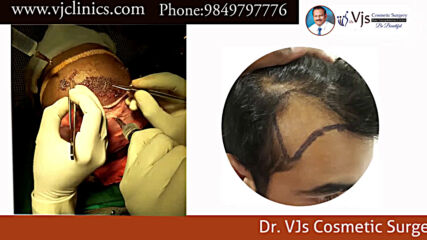 Live Hair Transplantation By Dr.c.vijay Kumar - Hair Transplant in Vizag.mp4